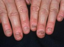 Методы избавления от привычки грызть ногти на руках Что сделать чтоб не грызть ногти
